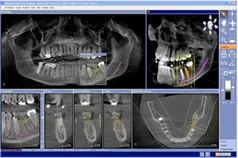 Dental Implant X-Ray