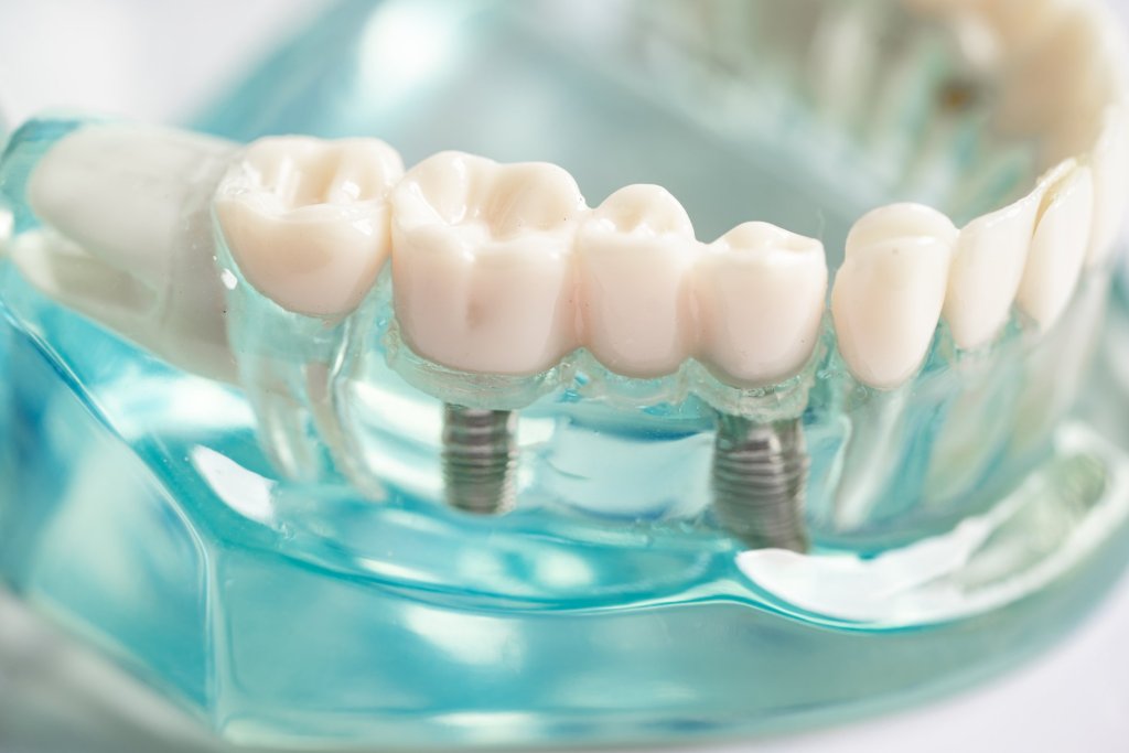 artificial tooth implant